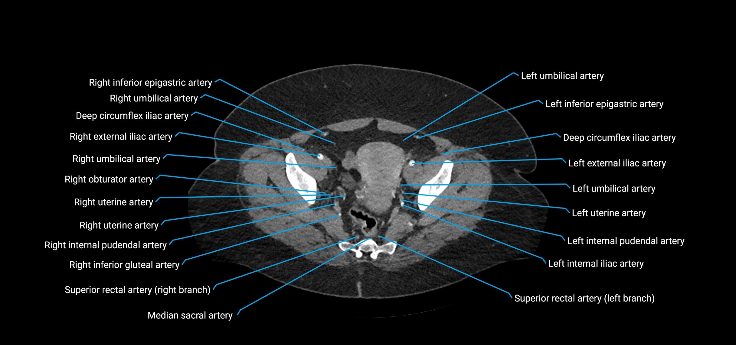 CTA abdomen axial cross sectional anatomy labelled image_218 (2).webp